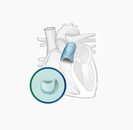 佰诺科™ 流出道单瓣补片